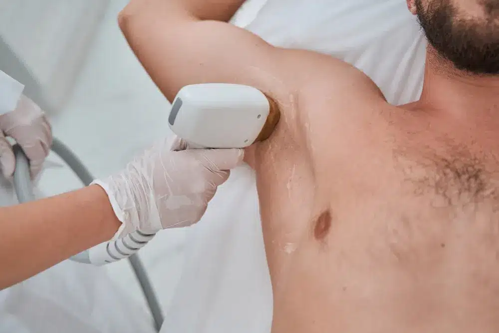 Diódalézeres szőrtelenítés férfiaknak - a hónalj szőrtelenítése